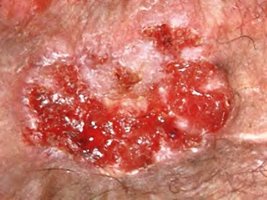 Squamous cell carcinoma