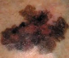 Malignant melanoma