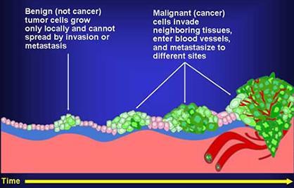 Diagram showing benign, malignant, and metastatic tumors