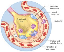 Covid-19 lung pathology