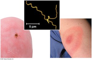 Lyme disease caused by bacteria