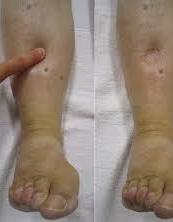 Photograph of legs with visible edema (swelling)
