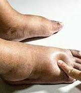 Photograph of swollen feet and ankles due to edema