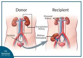 Diagram showing kidney transplant from donor to recipient