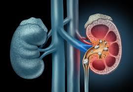 Illustration of kidney with stones forming in the renal pelvis