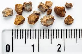 Photograph of kidney stones next to a ruler for size comparison