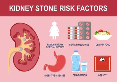 Infographic showing kidney stone risk factors: family history, medicines, food, digestive diseases, dehydration, obesity