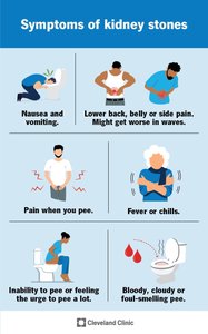 Infographic showing symptoms of kidney stones: nausea, pain, fever, blood in urine, etc.
