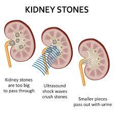 Diagram showing lithotripsy: ultrasound shock waves breaking up kidney stones