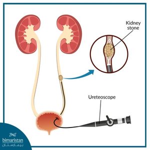 Diagram showing ureteroscope removing kidney stone from urinary tract