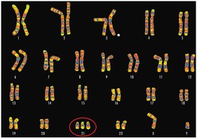 Karyotype showing trisomy 21 (Down syndrome)