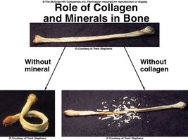 Osteogenesis imperfecta: brittle bones and blue sclerae