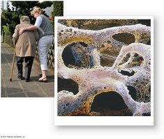 Osteoporotic bone structure in elderly