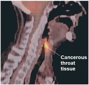 PET scan showing cancerous tissue