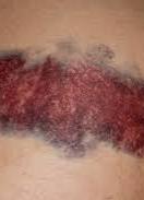 Bruise color changes over time