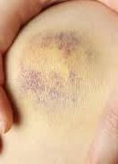 Bruise in early stage