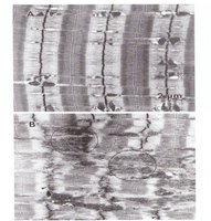 Electron micrograph of muscle injury