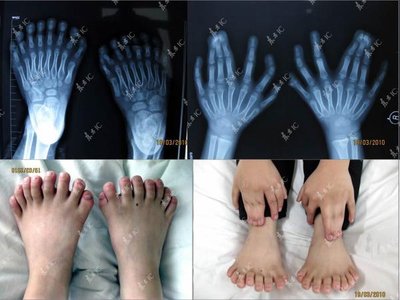Polydactyly: X-rays and photos of hands and feet with extra digits