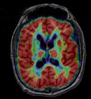 Brain scan showing Huntington's disease effects