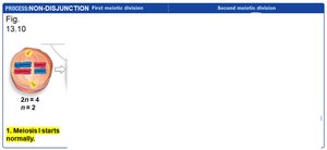 Non-disjunction: Meiosis I