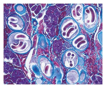 Trichinella juvenile in muscle tissue