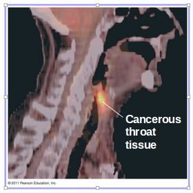 PET scan procedure