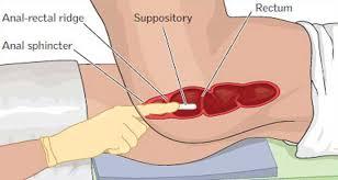 Rectal drug administration (suppository)