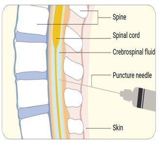 Intrathecal injection