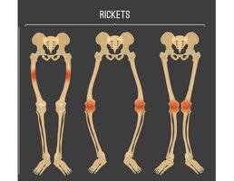 Rickets due to vitamin D deficiency