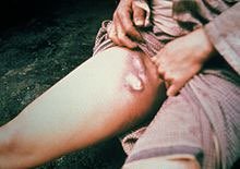 Bubonic plague bubo on thigh