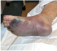 Septicemic plague on foot