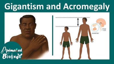 Gigantism and acromegaly comparison