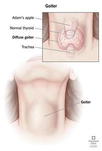Goiter (enlarged thyroid gland)