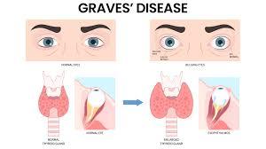 Graves' disease and exophthalmos