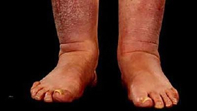 Myxedema (adult hypothyroidism)