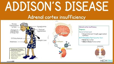 Addison's disease (adrenal cortex insufficiency)