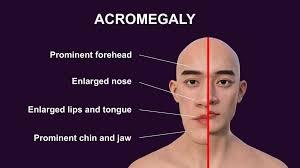 Acromegaly symptoms