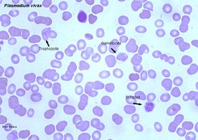 Plasmodium in blood cells