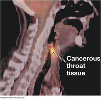PET scan showing cancerous tissue