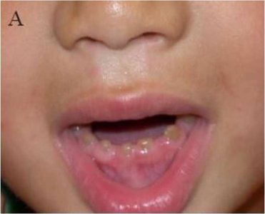 Dentinogenesis imperfecta