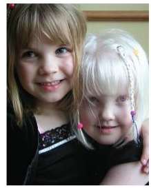 Children with albinism