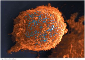 A human immune cell infected by HIV, releasing viral particles