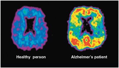 PET scan comparison: healthy vs. Alzheimer's patient