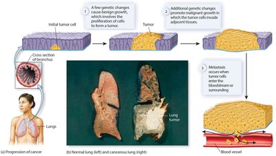 Progression of cancer from benign to malignant and metastatic stages