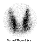 Normal thyroid scan using radioisotopes