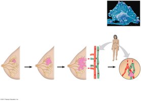 Progression and metastasis of cancer cells