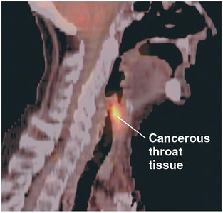 PET scan using radioactive isotopes