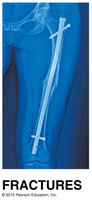 X-ray of a fractured bone with surgical repair