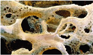Bone tissue with osteoporosis