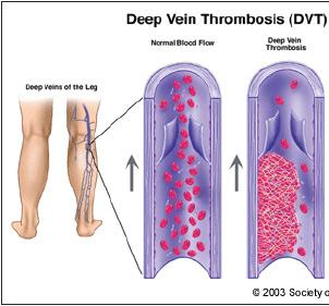 Diagram of deep vein thrombosis (DVT)